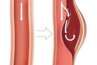 aortic-dissection-stages