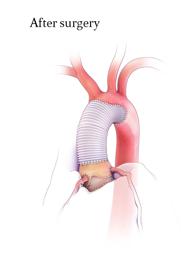 Porcine BioRoot Replacement (with Hemiarch Replacement)