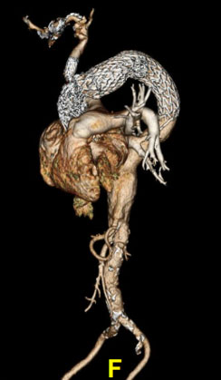Post-Op Stent Graft