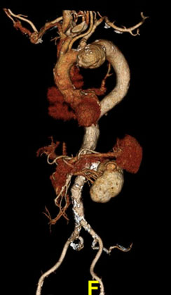 Pre-Op Stent Graft