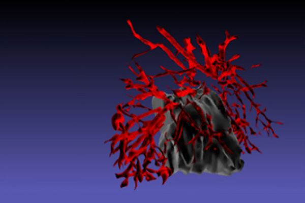 New artificial intelligence (AI)-derived biomarker