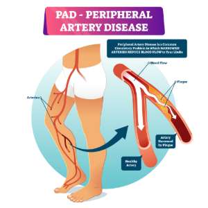 PAD - Peripheral Artery Disease graphic