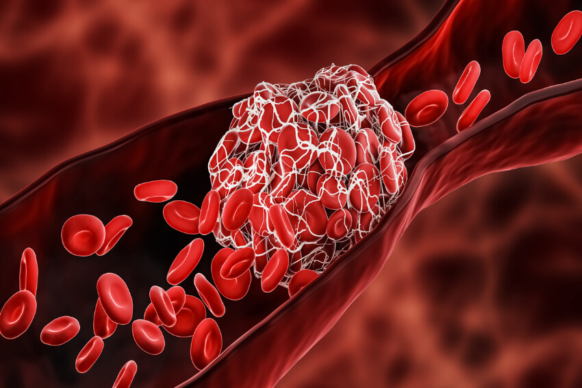 illustration of a blood clot