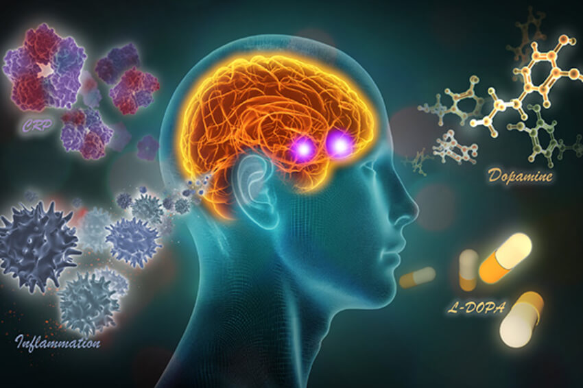 graphical depiction of a brain affected by inflammation, dopamine and L-Dopa